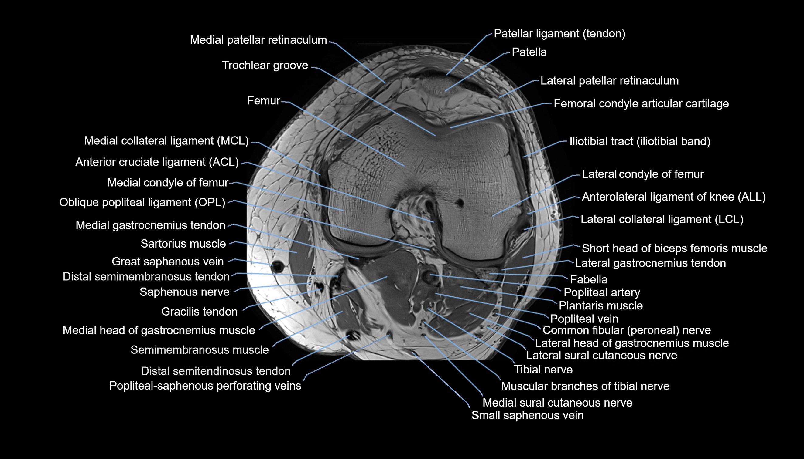MRI knee  axial cross sectional anatomy 3T radiology  image-img-00001-00022.webp